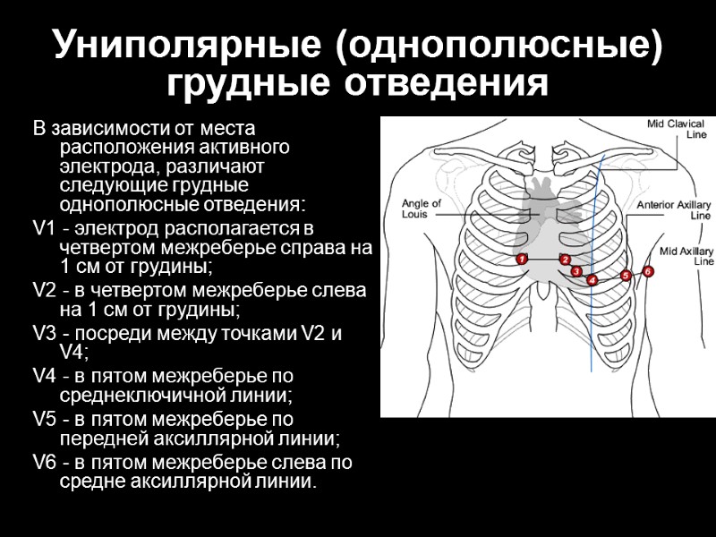 Униполярные (однополюсные) грудные отведения В зависимости от места расположения активного электрода, различают следующие грудные